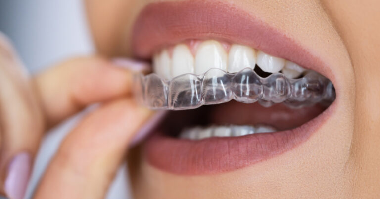 capa invisalign 1